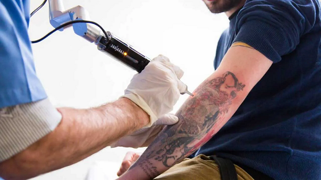 Fitness and Tattoo Removal: What You Should Know